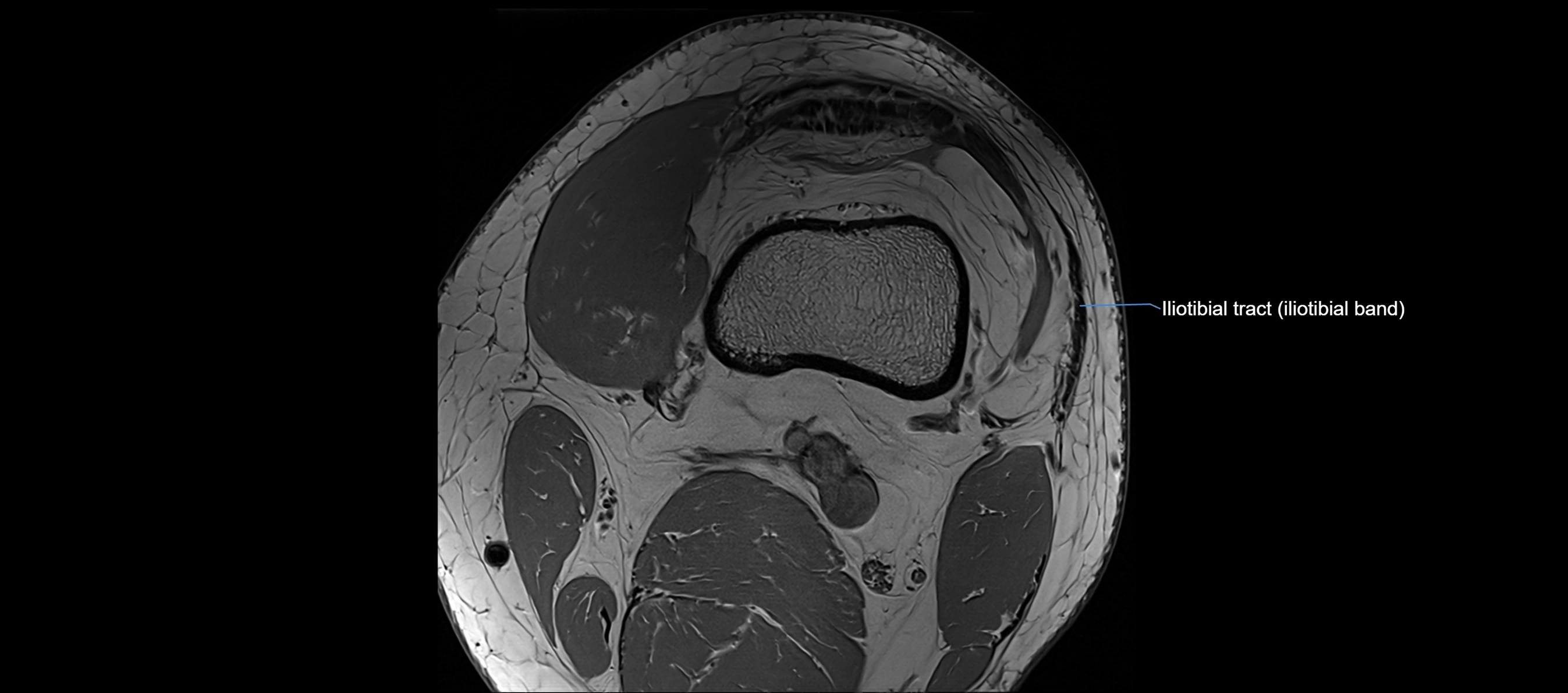 MRI Knee axial  ligaments cross sectional anatomy 3T  radiology  image-img-03001-00005.webp